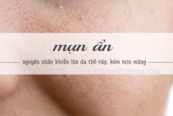 cách trị mụn ẩn